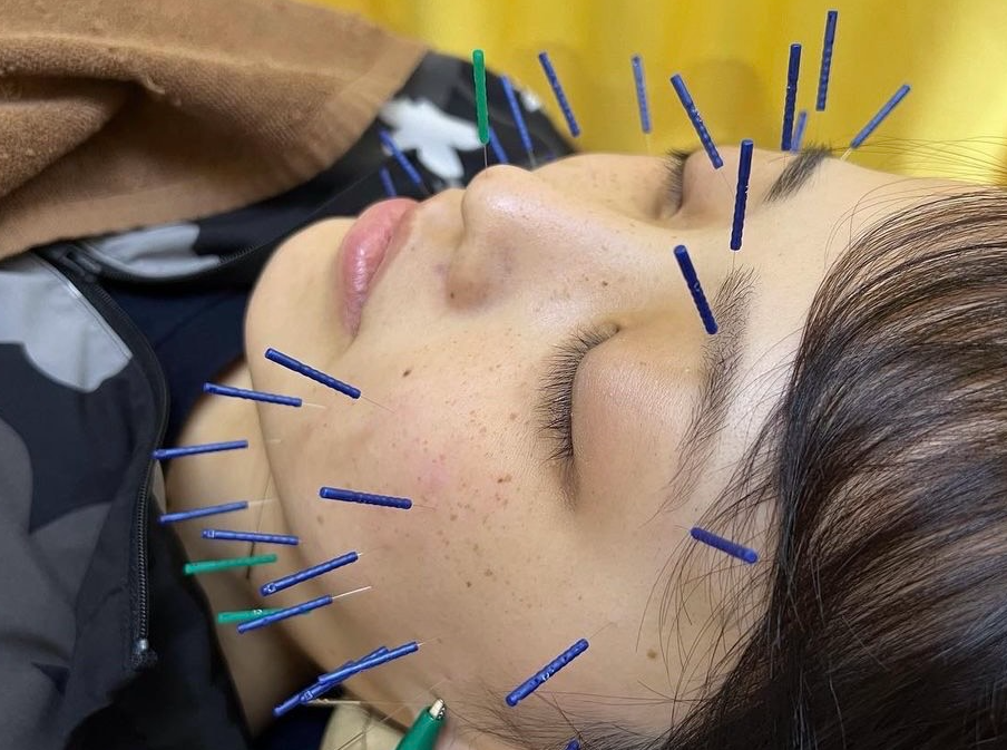 美容鍼で小顔効果！