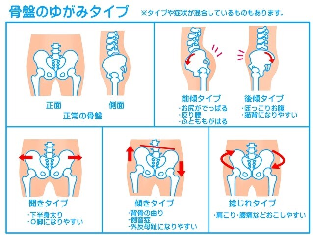骨盤の歪み、チェックしましょう！