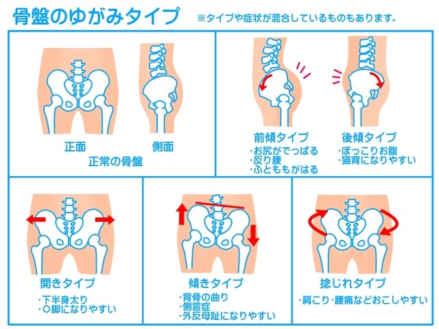 あなたの骨盤はどのタイプ？