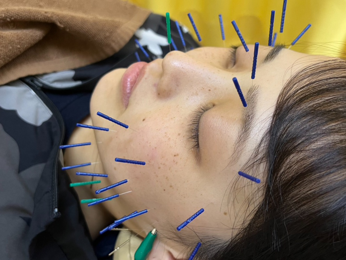 美容鍼やってます！