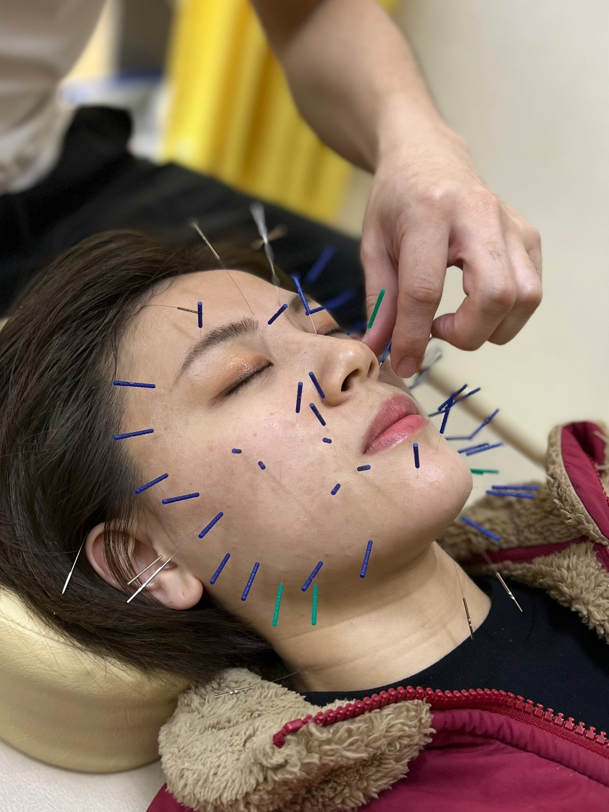 美容鍼、当日受付出来ます！