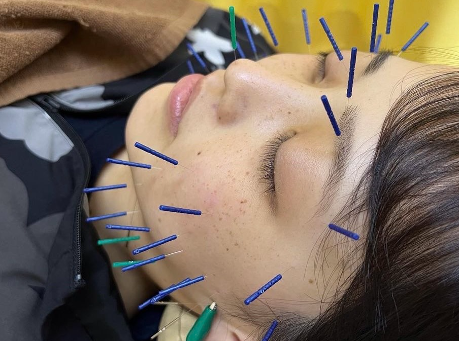 美容鍼やってます！