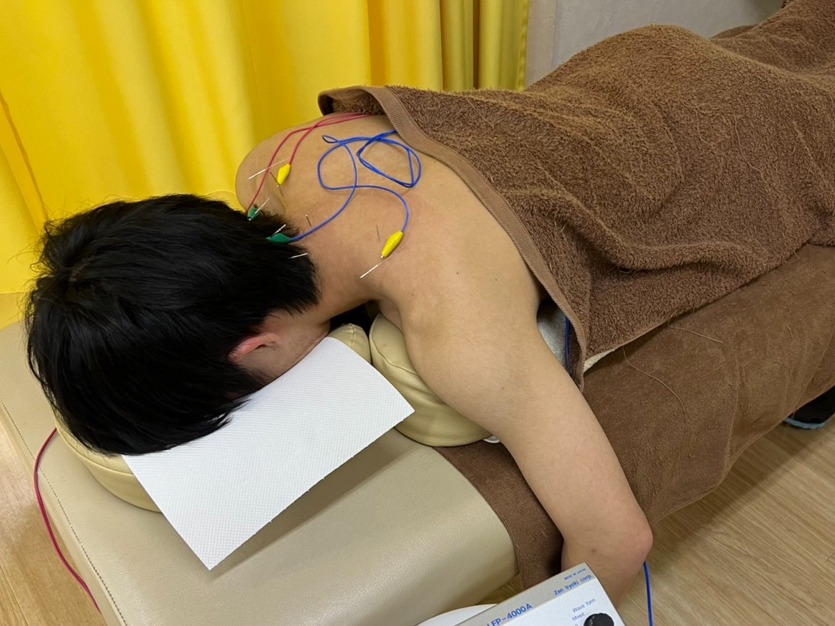 鍼効果、実感してみてください！