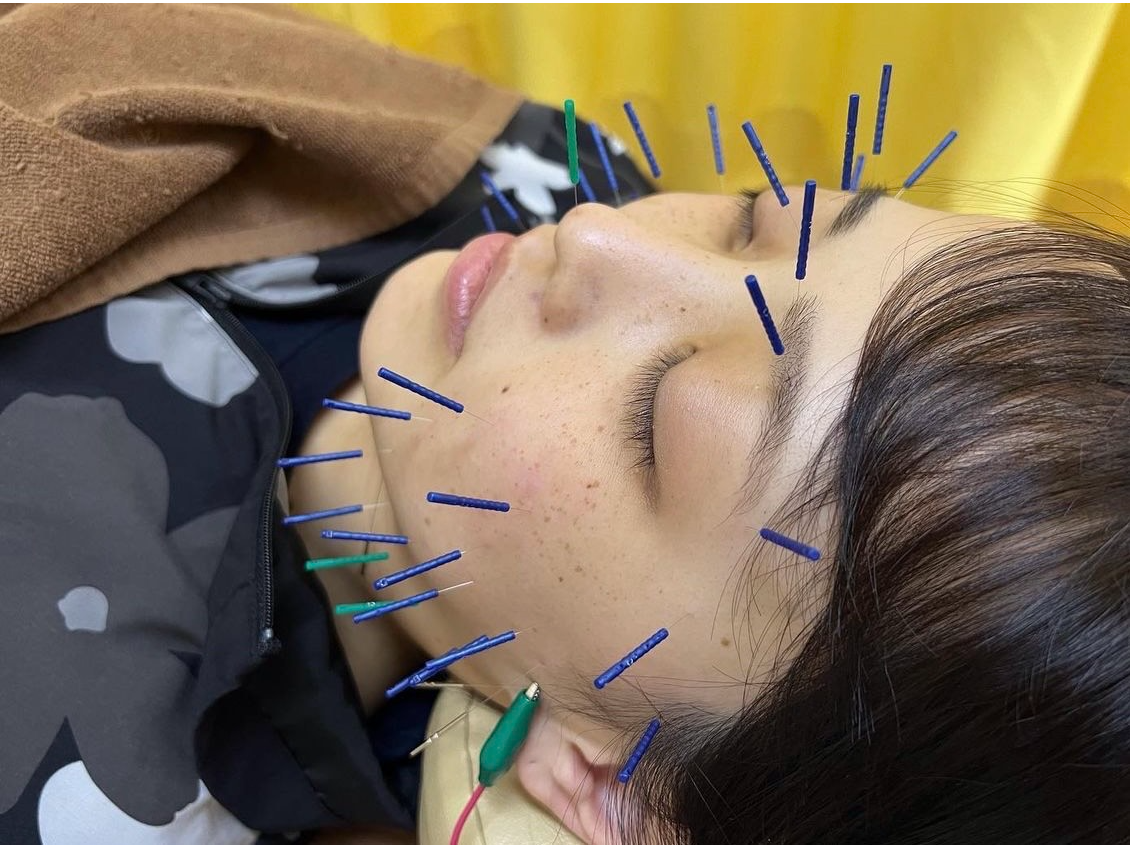 美容鍼、お試しください！