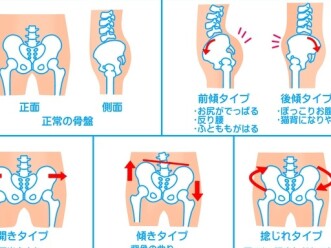 骨盤の歪みが痛みの原因？？